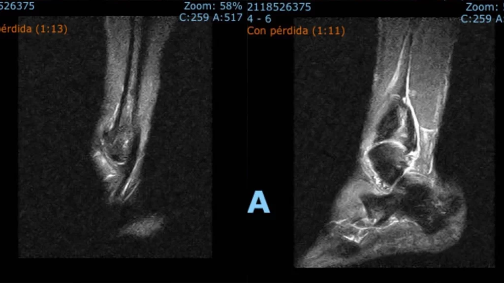 Imágenes de la fractura de tobillo Fernando Adrián